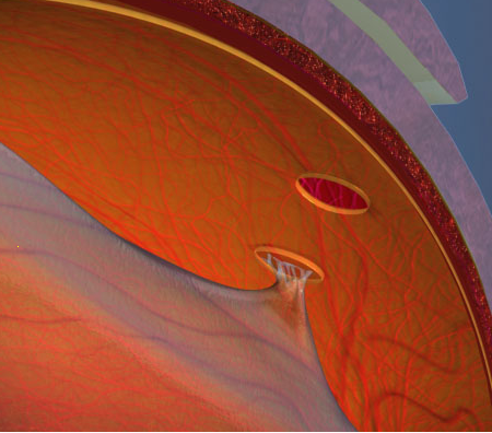 agujero de retina